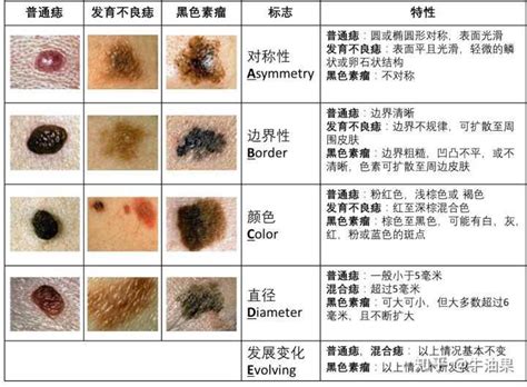 凸起來的痣|痣是什麼？會變成黑色素瘤？7種一定要除的痣